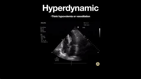 hyperdynamic lv|hyperdynamic left ventricle stress test.